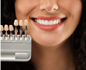 Facetas em Resina