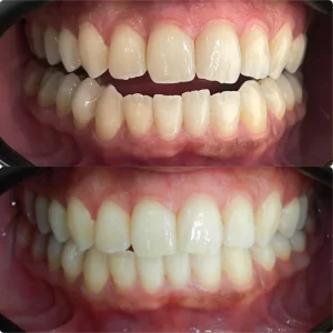Result facetas 1