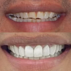 Result facetas 3