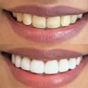 Result facetas 4